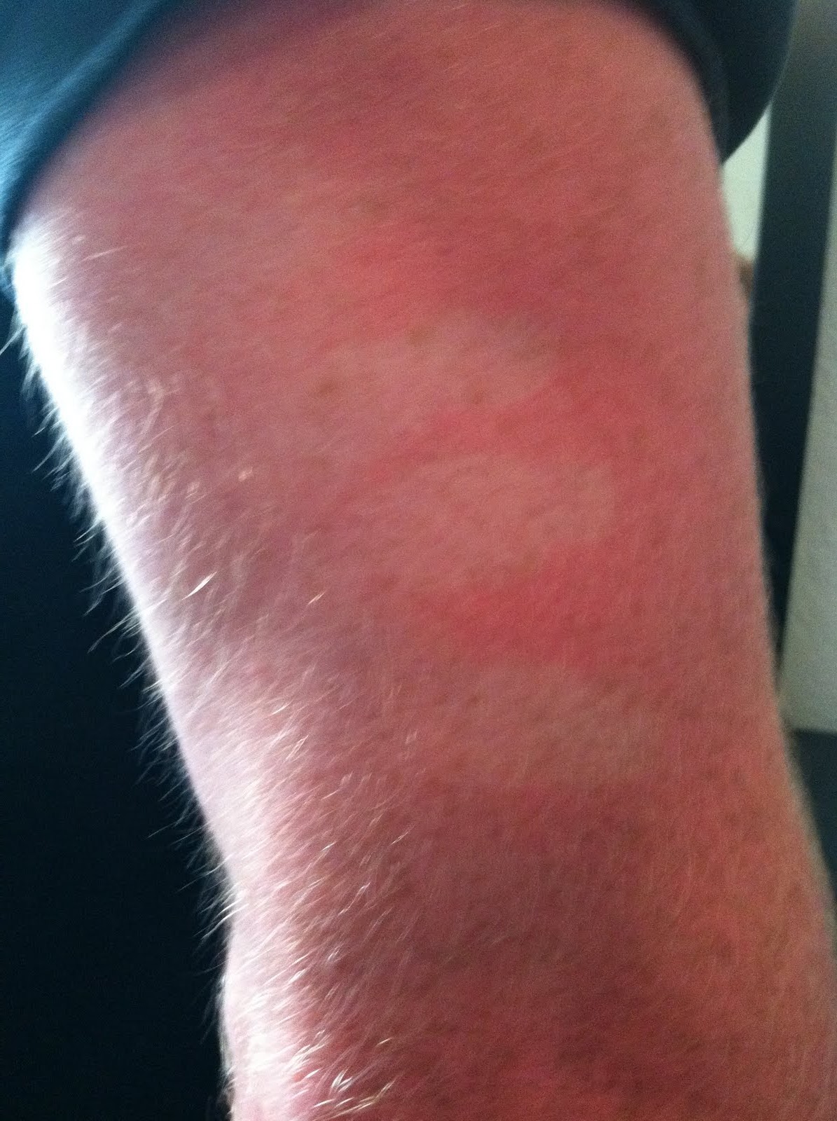 Sunburn Pictures - MedicineNet