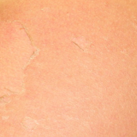 Treating Sunburn Peeling The Easy Way